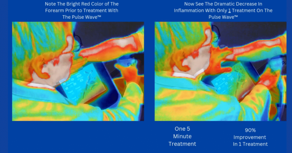 Shockwave Therapy Decreased Inflammation Illustration